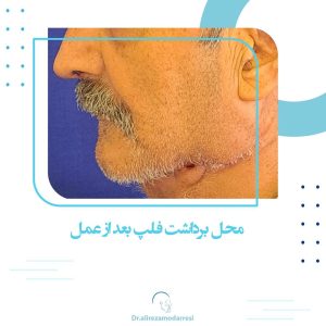 جراحی سرطان زبان با درگیری غذذ لنفاوی