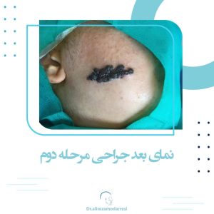 نمای بعد جراحی مرحله دوم خال بزرگ صورت