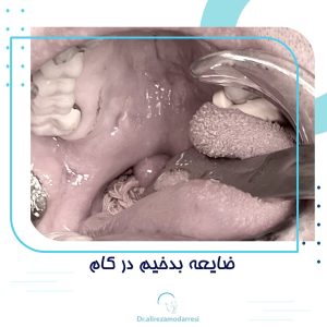 ضایعه بدخیم در کام