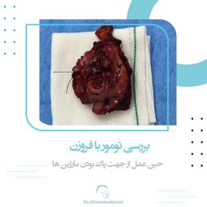 بررسی تومور با فروزن حین عمل از جهت پاک بودن مارژین ها
