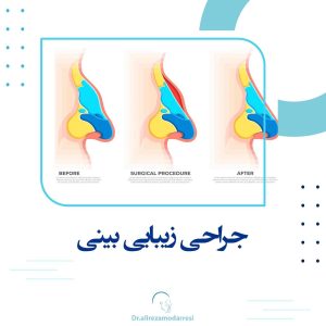 جراحی زیبایی بینی توسط دکتر علیرضا مدرسی