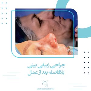 جراحی زیبایی بینی (سپتو رینوپلاستی ) بلافاصله بعد عمل