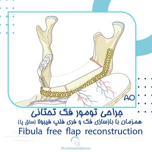 جراحی تومور فک تحتانی همزمان با بازسازی فک و فری فلپ فیبولا