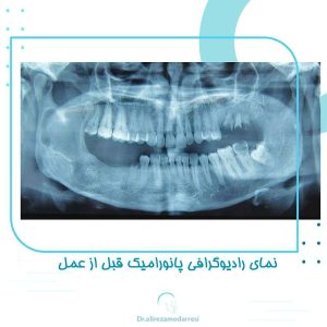 نمای رادیوگرافی پانورامیک قبل از عمل