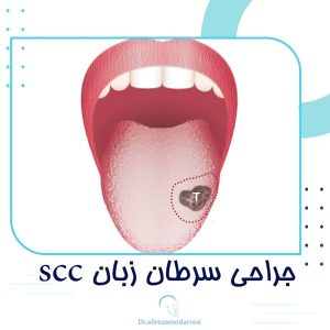 جراحی سرطان زبان