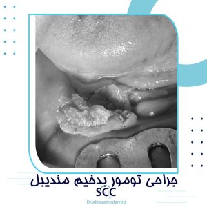 جراحی تومور بدخیم مندیبل