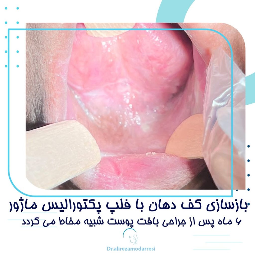 بازسازی کف دهان با فلپ پکتورالیس ماژور
۶ ماه پس از جراحی بافت پوست شبیه مخاط میگردد