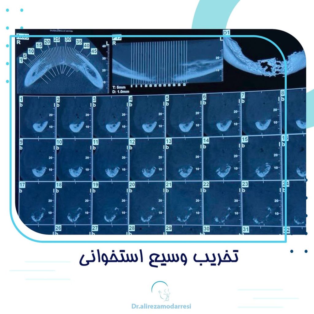 تخریب وسیع استخوانی در تومور بدخیم مندیبل