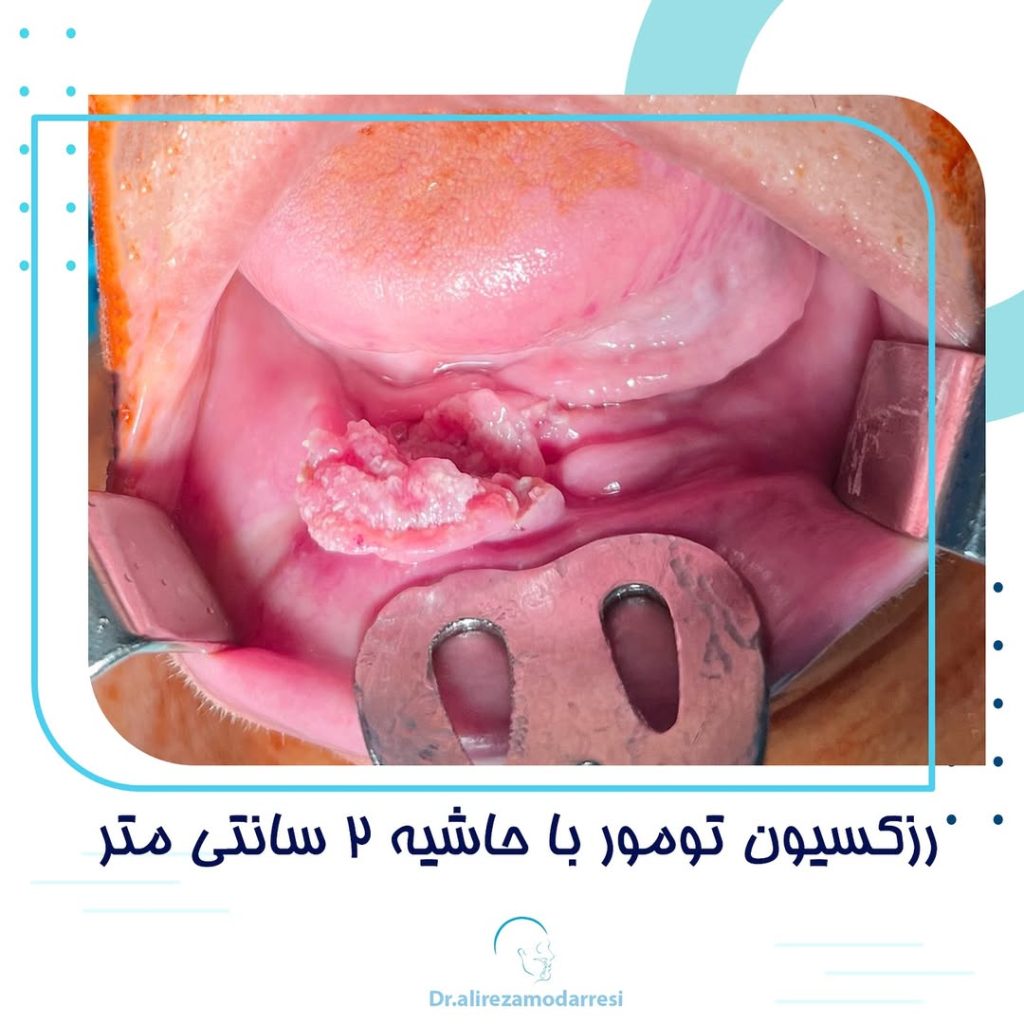 رزکسیون تومور با حاشیه 2 سانتی متر در جراحی تومور بدخیم مندیبل