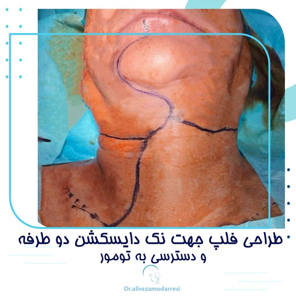 طراحی فلپ جهت نک دایسکشن دو طرفه و دسترسی به تومور