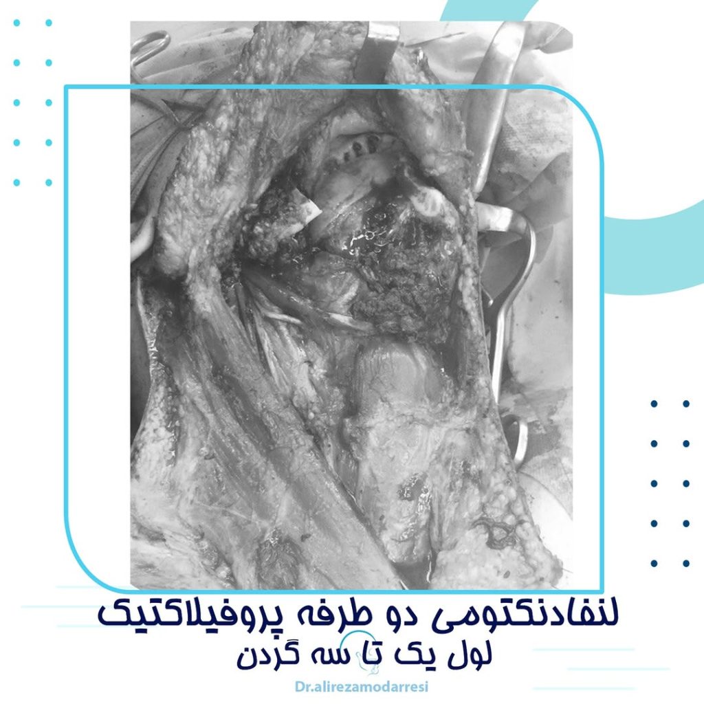 لنفادنکتومی دو طرفه پروفیلاکتیک لول یک تا سه گردن