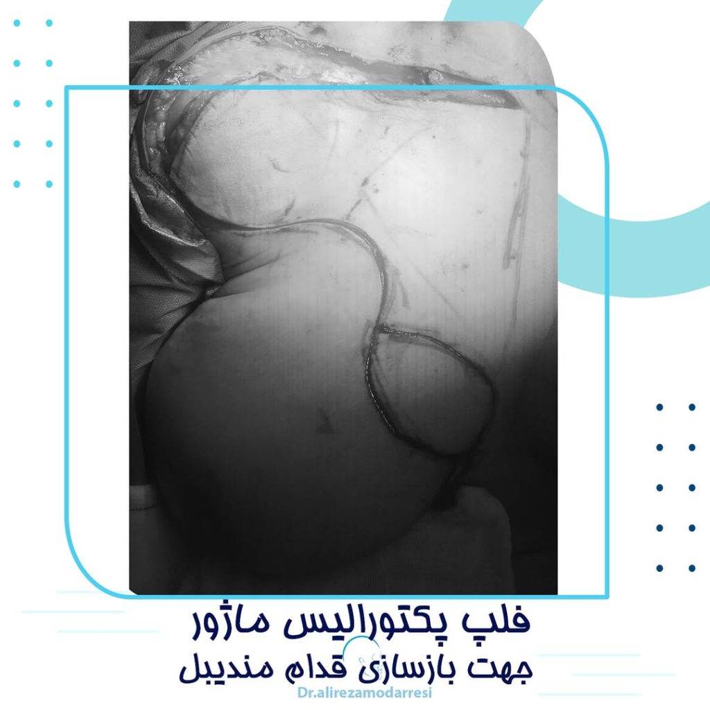 فلپ پکتورالیس ماژور
جهت بازسازی قدام مندبیل