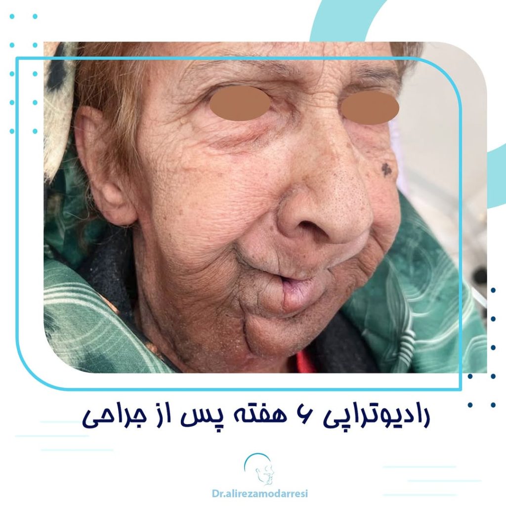 رادیوتراپی 6 هفته پس از جراحی