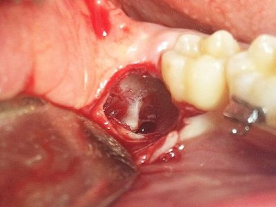 جراحی دندان عقل چگونه انجام می شود؟